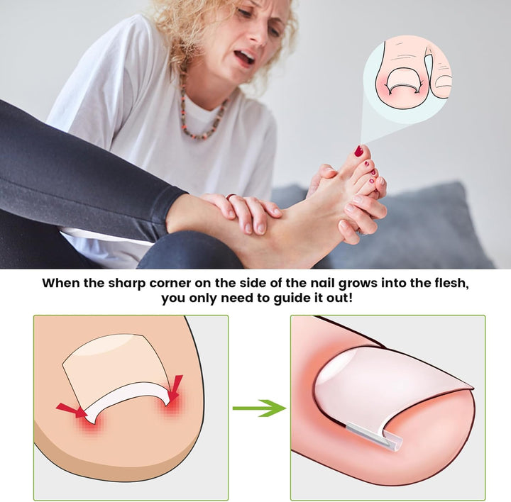 Ingrown Toenail Corrector Set - 40 Pcs Pain-Free Toenail Straightener Strips with Toenail Lifter - Easy Use Ingrown Toenail Tools Kit