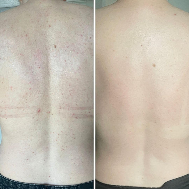 Salicylic Acid Spray against Body Breakouts, Clogged Pores and Rough Skin – with 2% Salicylic Acid and Glycolic Acid for Clearer, Smoother Skin