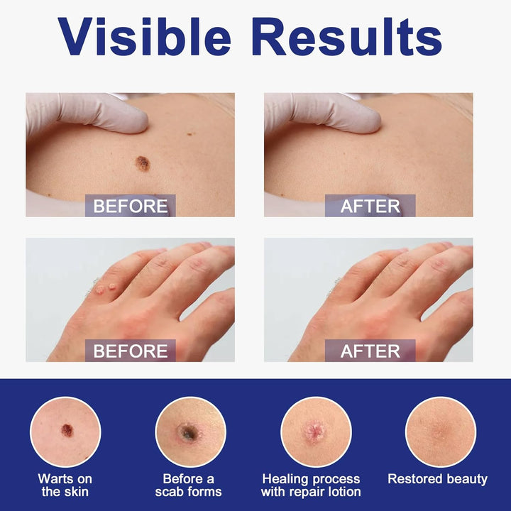 3Pcs Skin Tag Removal Kit, Wart Removal Pen 4ML, Effectively Targets Skin Tags, Mole, Calluses on Body (3)