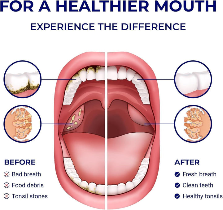 Manual Water Flosser | Tonsil Stone Irrigator | Soft Floss Remover | Mini Tonsil Cleaner | Travel, Teeth Cleaning Space | Orali