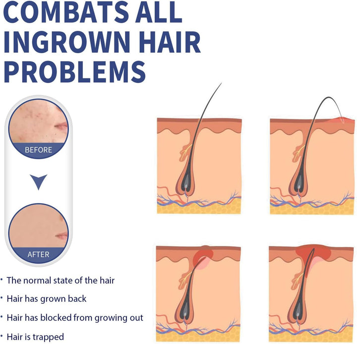 Razor Bumps Treatment for Women and Men, after Shave Solution Roll-On for Ingrown Hairs, Razor Bump Treatment for Face,Neck, Legs, and Underarm Area, Ingrown Hair Serumazor，Smooth Skin(90Ml)