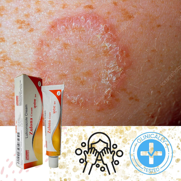 Zulona Cream – Luliconazole 1% Antifungal Treatment for Ringworm, Athlete'S Foot & Jock Itch – Relief Whithin 24Hr from Itching, Redness & Fungal Infections – Topical Azole Class Cream.
