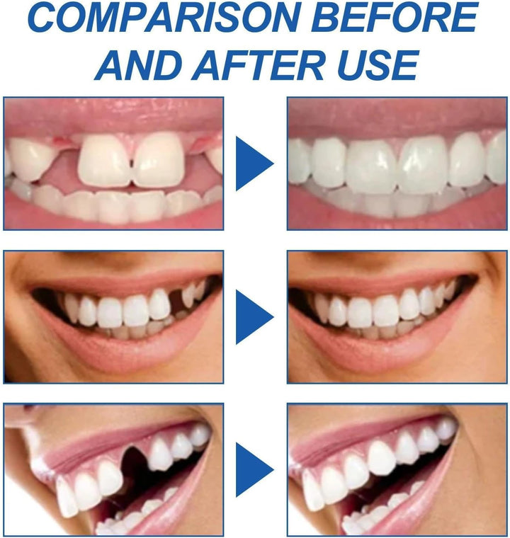 Temporary Tooth Filling Repair Kit for Broken, Chipped, or Missing Teeth - Replace with False Teeth and Filler