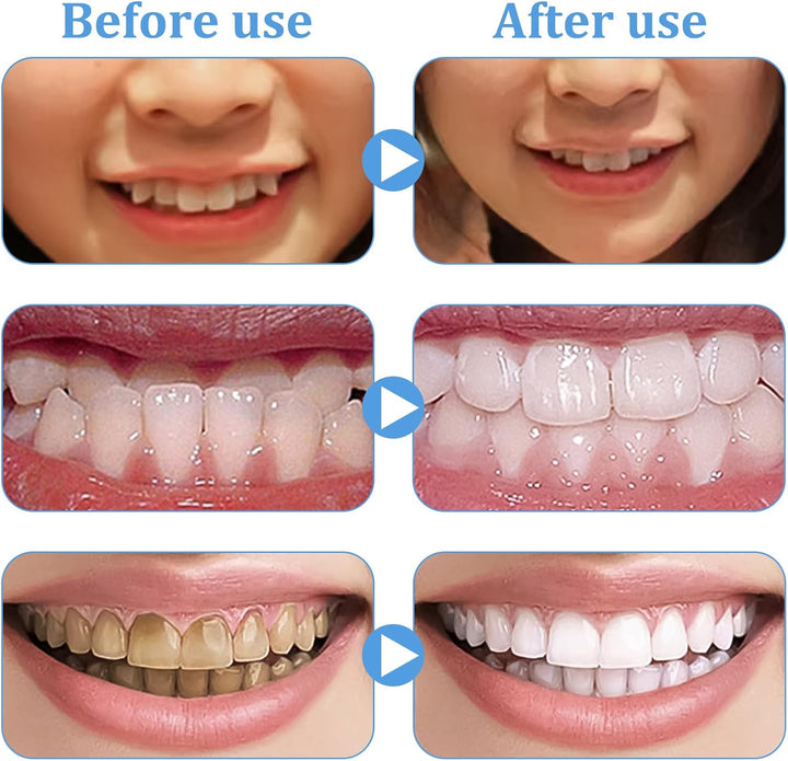 6Pcs Teeth Whitening Gum Shield Teeth Whitening Trays Teeth Whitening Mouth Trays Mouth Guard for Teeth Grinding Teeth Retainers Teeth Grinding Guard for Teeth Whitening Grinding Protecting