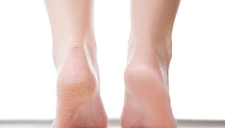 eady Corn & Callus Trimmer - Instant Relief from Corns | Removes Dry, Hard & Cracked Skin | Home Pedicure Treatment for Footcare