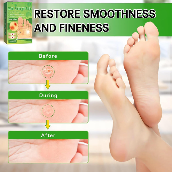 Wart Remover, 30Pcs Verruca Treatment, Plantar Wart Remover for Hands, Feet, Effective Deep Verruca Removal Pads Patches, Pain Relief, Non-Irritating Wart Treatment for Adults