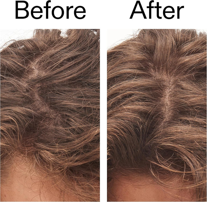 7% Glycolic Acid Exfoliating Scalp Scrub 150Ml, Removes Product Build Up, Hair Growth, Fragrance Free, Suitable for All Hair Types