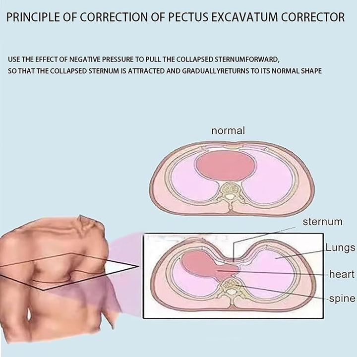 Pectus Excavatum Orthosis Brace,Pectus Excavatum Vacuum Bell,Pectus Excavatum Orthosis Brace,Chest Support,W/Pressure Gauge, Sternal Depression (121)