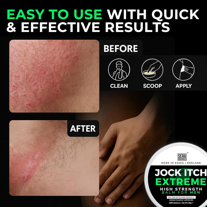 Jock Itch Cream for Men – Antifungal Treatment for Groin, Itching, & Rash | Strong Jock Itch Relief Balm | Natural Antifungal Skin Cream (30Ml) – Made in UK