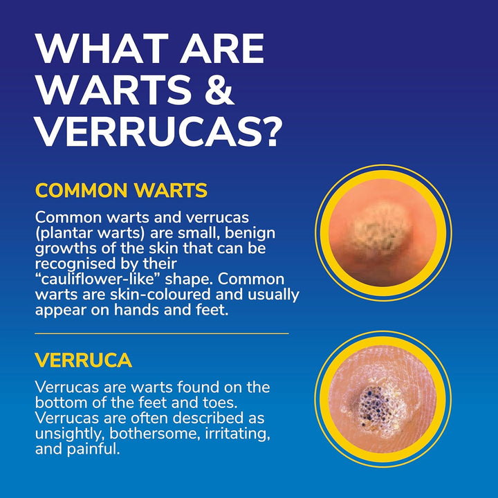 Freeze Away Max Verruca and Wart Remover for Hands and Feet - as Fast as 10 Seconds to Treat Warts and Verrucas, Safe for Children Aged 4 and Above