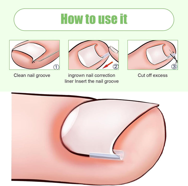 40 Pcs Ingrown Toenail Correction Strips, Toenail Straightener Strips, with Toenail Lifter, Ingrown Toenail Treatment Kit, Toenail Recover Clips, for Women Men Foot Care