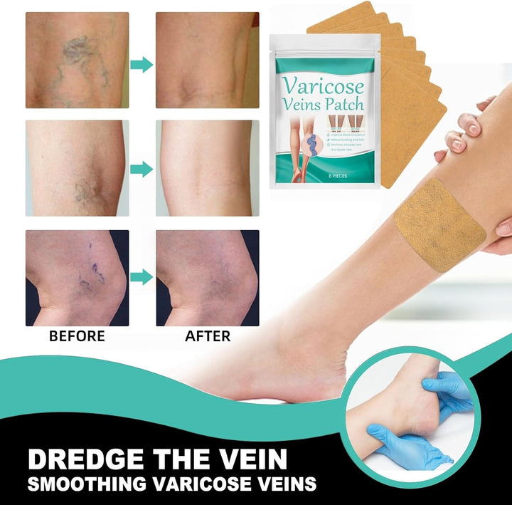 Varicose Veins Treatment for Legs,Spider Veins Removal for Legs Treatment Patch,Varicose Veins Patches,Varicose Veins Relief,Relief Pain Leg Care,Improve Blood Circulation,Wide Range of Application