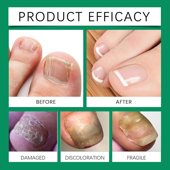 Nailshield anti Fungal Stick, Nail Shield anti Fungal Stick, Natural Nail Strengthener for Damaged Nails