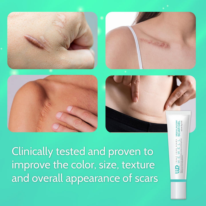 Silicone Scar Gel Removal Cream: Scar Treatment for Burns, Surgery, and Stretch Marks – Suitable for Old and New Scars – Improves Appearance on Face and Body, 30G