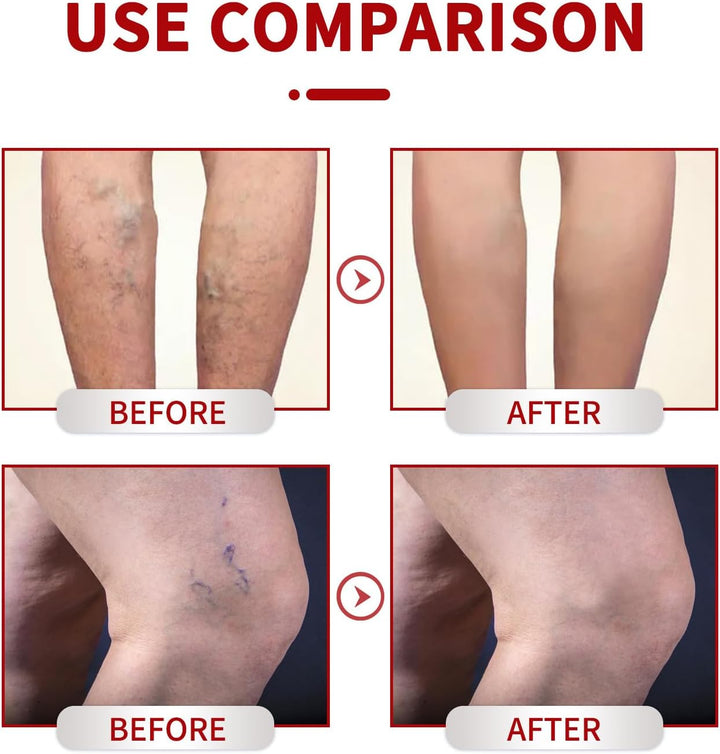 Cream for Varicose Veins in Legs,Varicose Veins Cream,Vein Relief Cream,Vein Cream for Legs,Varicose Veins Treatment Cream,Varicose Vein Removal Cream,Improve Blood Circulation,20G,1Pc