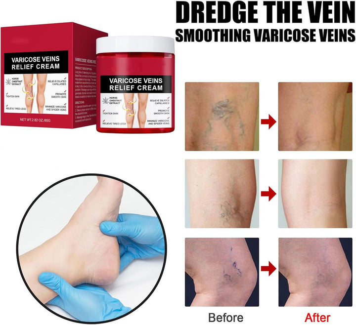 80G Varicose Veins Relief Cream, Varicose Veins Treatment for Legs, Varicose Veins Cream Vein Relief Cream Varicose Veins Treatment Cream for Legs Aching Legs Relief, Spider Veins Repair Cream