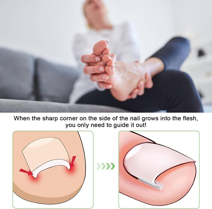 40 Pcs Ingrown Toenail Correction Strips, Toenail Straightener Strips, with Toenail Lifter, Ingrown Toenail Treatment Kit, Toenail Recover Clips, for Women Men Foot Care