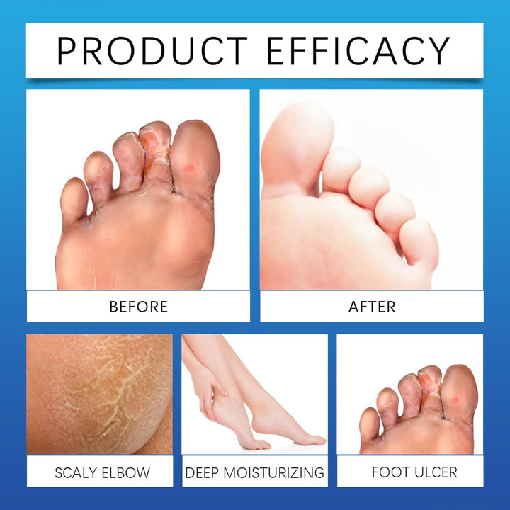 Diabetic Foot Cream 20G, Professional Feet Cream for Diabetic Feet, Foot Moisturise and Soothing Itching, Suitable for Diabetics