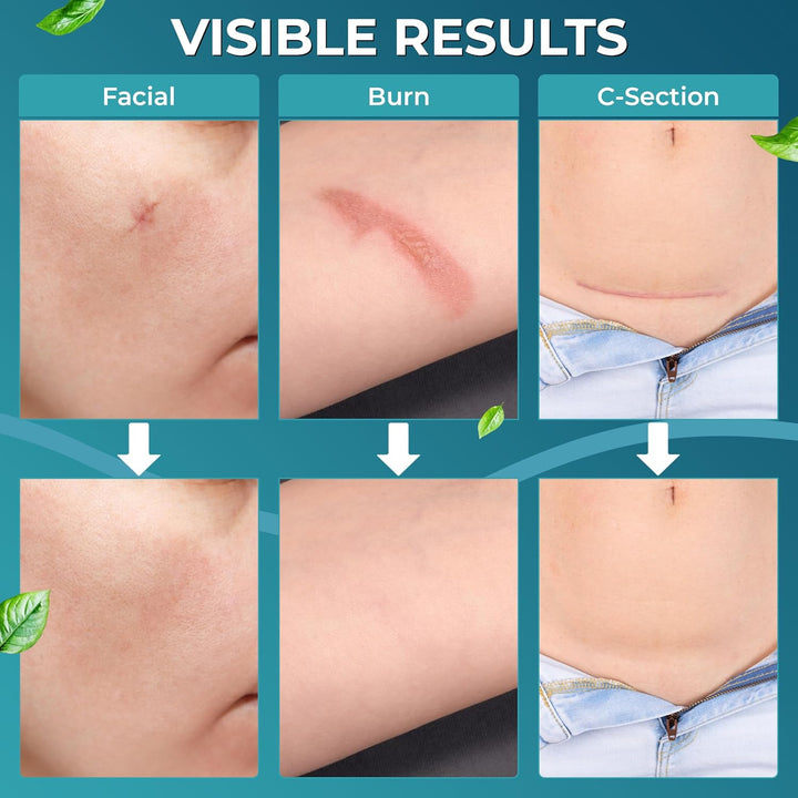 Medical Grade Silicone Scar Tape | 4Cm X 1.2M | Silicone Scar Sheets for after Surgery C Section Recovery, Wrinkles Removal, Face Treatment Gel Patches/Plasters