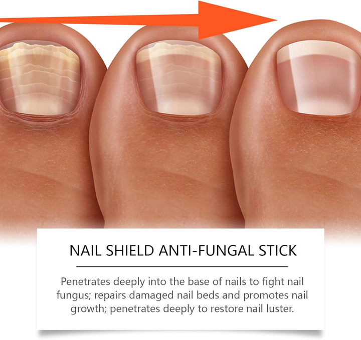 Nailshield anti Fungal Stick, Nail Shield anti Fungal Stick, Natural Nail Strengthener for Damaged Nails