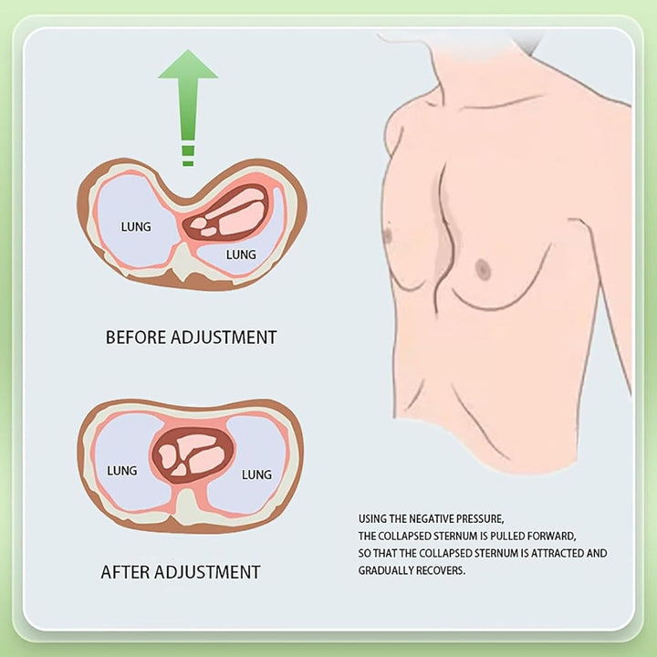 Pectus Excavatum Corrector,Pectus Excavatum Vacuum Bell for Adults and Child,Physical Correction,Washable,With Pressure Gauge,L