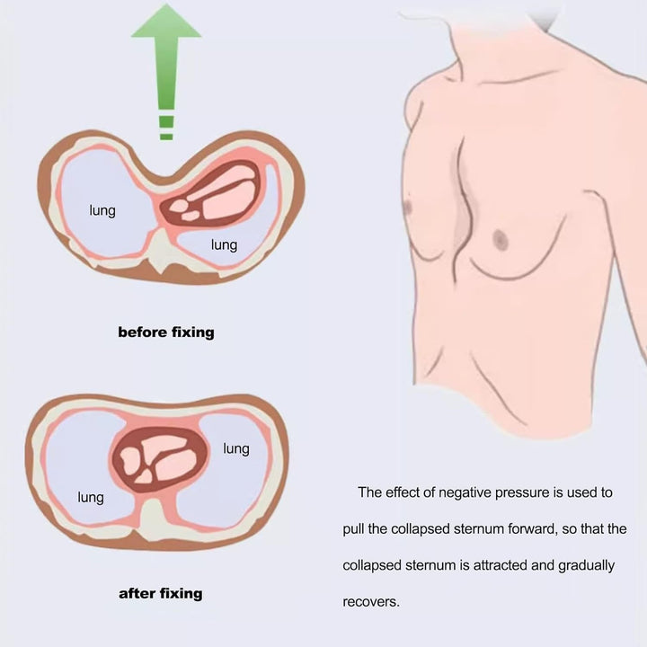 Pectus Excavatum Vacuum Bell/Sunken Chest/Non-Surgical Treatment(L-L)