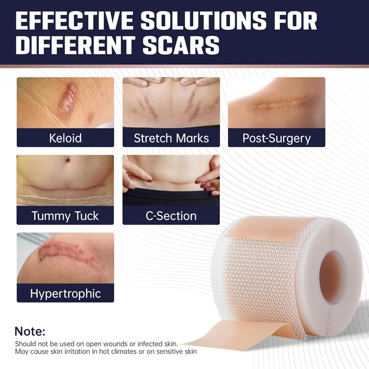 Silicone Scar Tape 4Cm X 1.5M | Medical Grade Silicone Sheets for Scar Care | Suitable for Surgery, C Section, Burns, Acne Marks and Stretch Marks | Soft, Reusable, Waterproof