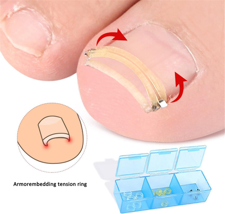 Ingrown Toenail Corrector, Stainless Steel Curved Toenail Straightener with Rubber Bands, Ingrown Toenail Removal Kit, Professional Ingrown Toenail Pedicure Tools for Men Women Curved Nail Repair