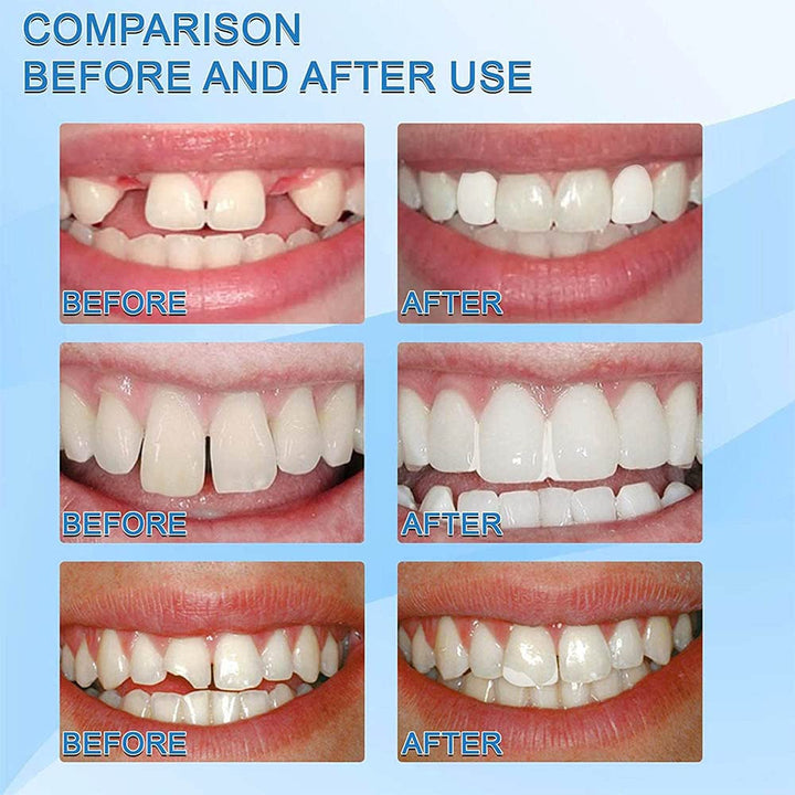 Temporary Tooth Repair Kits,Dental Repair Denture Repair Beads for Temporary Fixing Filling Missing Broken Tooth Moldable Fake Teeth