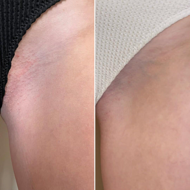 Healing Intimate Oil for down There | Ingrown Hairs, Razor Bumps after Shaving Bikini Line | Fragrance-Free Natural Itch Relief for Dry Skin | UK Made Vegan & Cruelty-Free Skincare | 30Ml