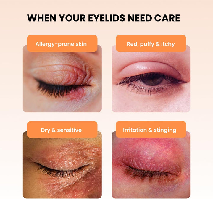 BLEPHADERM 5-In-1 Eyelid & Eye Contour Cream - Soothes, Repairs, Moisturises, Protects & Reduces Appearance of Puffiness for Sensitive, Dry, Irritated Skin 40Ml