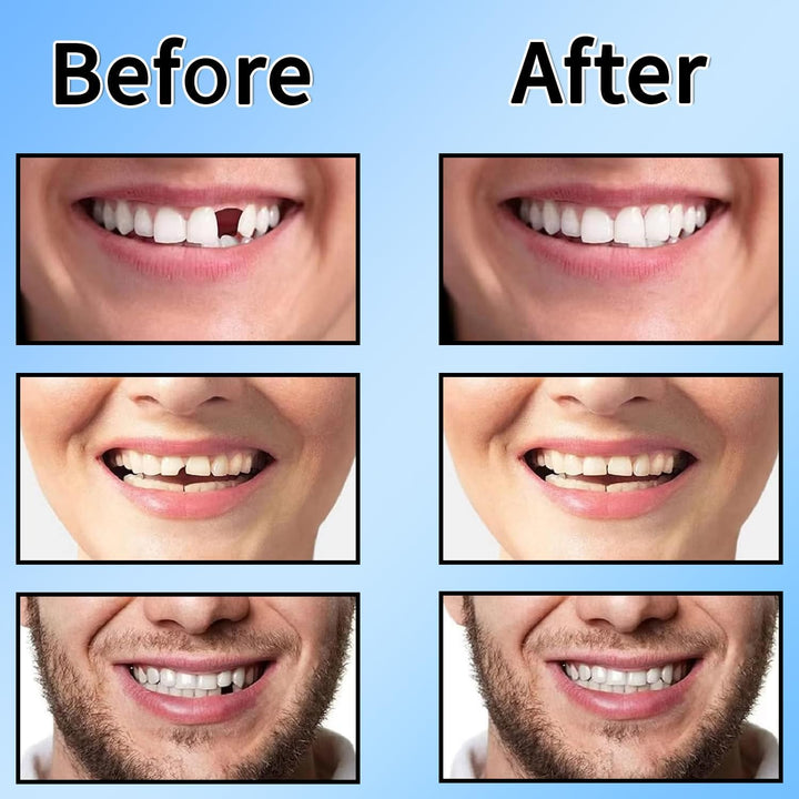 Tooth Filling Repair Kit,Dental Temporary Tooth Filling for Missing Broken Tooth Moldable Fake Teeth（10Ml）