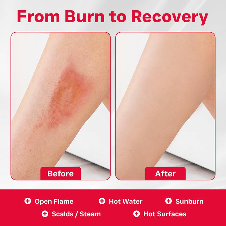 First Aid Burns Dispenser in Compact Red Piccolo Box - Refillable First Aid Kit with Burn Gel, Gloves and Burn Dressings - Essential Medical Equipment for Home, Workplace, or Car