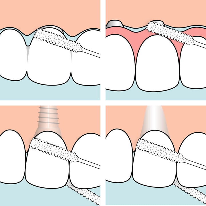 Bridge & Implant Floss, 30Pcs, Wide Dental Floss Suitable for Braces, Bridges, and Implants, Efficient Plaque Remover Tool for in between the Teeth