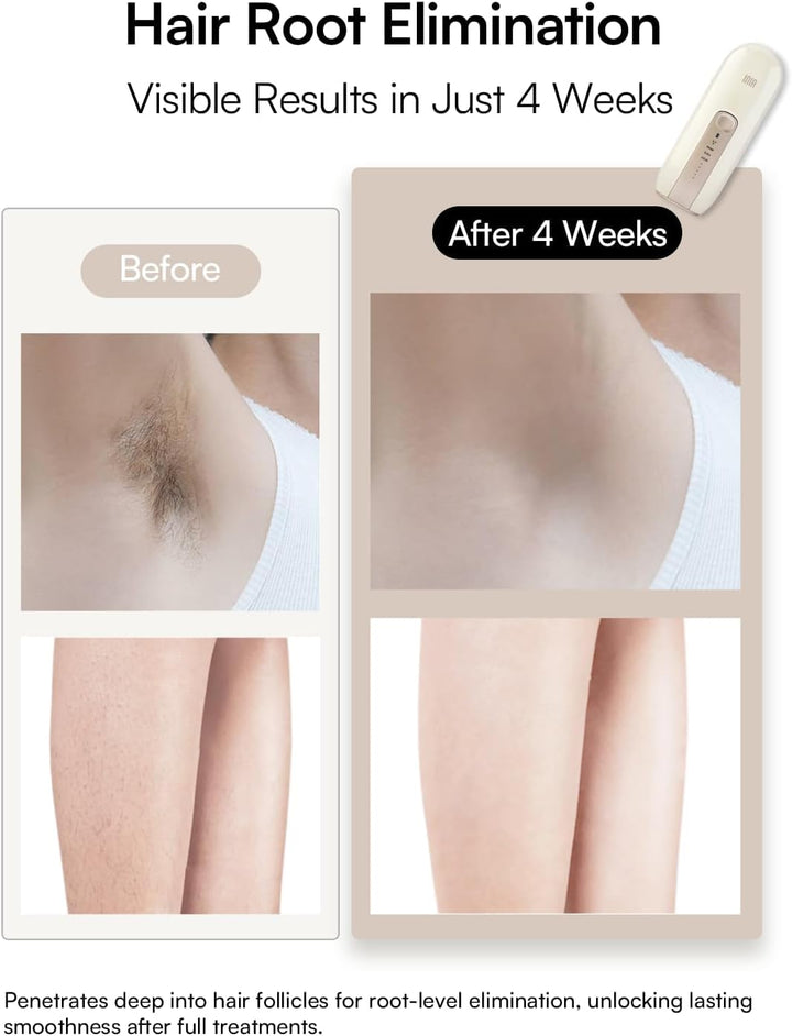 Laser Hair Removal Device for Women and Men,  Fond Hair Remover with Long-Lasting in Hair Reduction for Body&Face, Safe At-Home Results for Armpits, Bikini and Legs