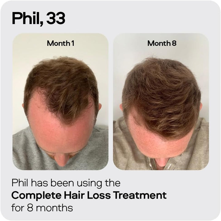 Minoxidil 5% Spray (1X60Ml) & 0.25Mm Dermaroller for Men, Clinically Proven Hair Regrowth Formula, Hair Loss Treatment, Stimulates Follicles, Precise Applicator, Microneedling Boosts Absorption