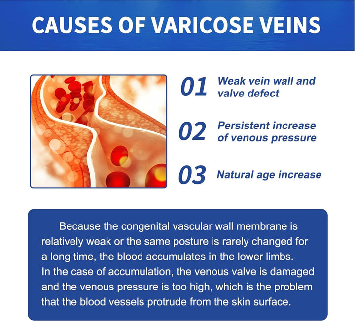 Leg Varicose Ointment,Varicose Vein Gel,Varicose Vein Removal Cream,Vein Relief Cream for Pain Relief, Natural Varicose,20G
