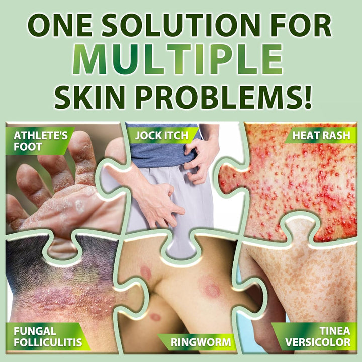 Tea Tree Oil Antifungal Cream: Natural Treatment for Athlete'S Foot, Jock Itch, Ringworm, Eczema, and Tinea Versicolor, Soothing & Hydrating Formula, 100G