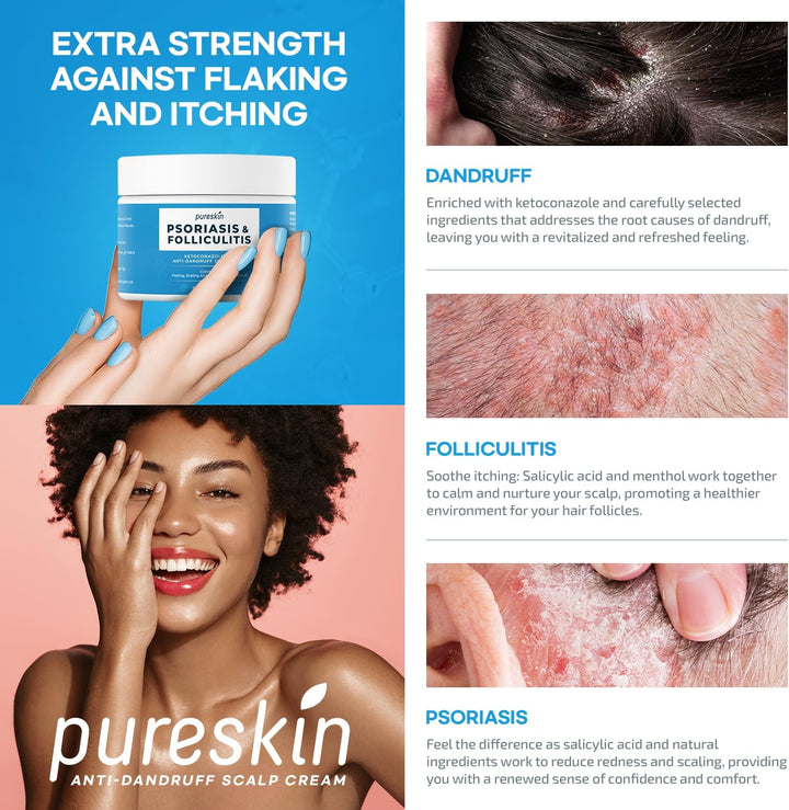 Psoriasis Scalp Treatment Cream - Extra Strength for Scalp Psoriasis Folliculitis - Controls Itching Flaking Stubborn Dandruff 3.4 Oz