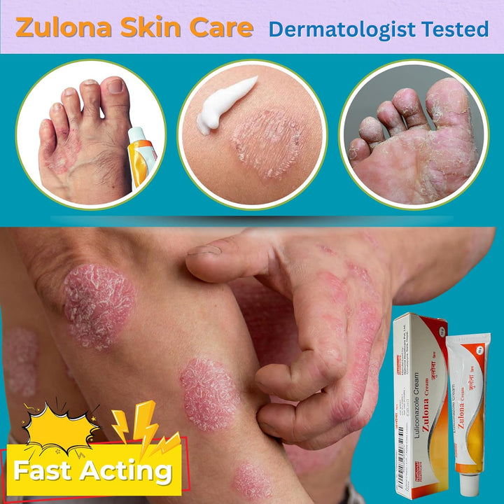 Zulona Cream – Luliconazole 1% Antifungal Treatment for Ringworm, Athlete'S Foot & Jock Itch – Relief Whithin 24Hr from Itching, Redness & Fungal Infections – Topical Azole Class Cream.