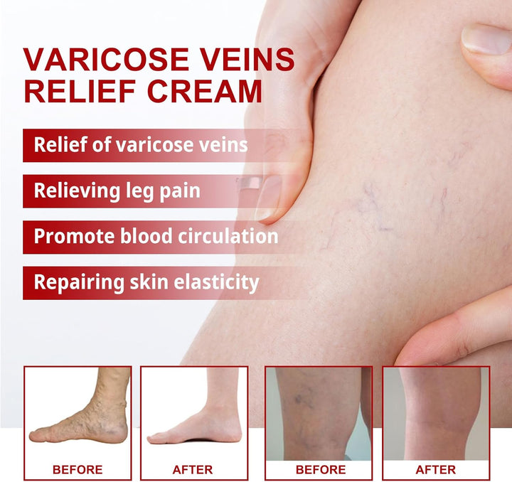 Cream for Varicose Veins in Legs,Varicose Veins Cream,Vein Relief Cream,Vein Cream for Legs,Varicose Veins Treatment Cream,Varicose Vein Removal Cream,Improve Blood Circulation,20G,1Pc