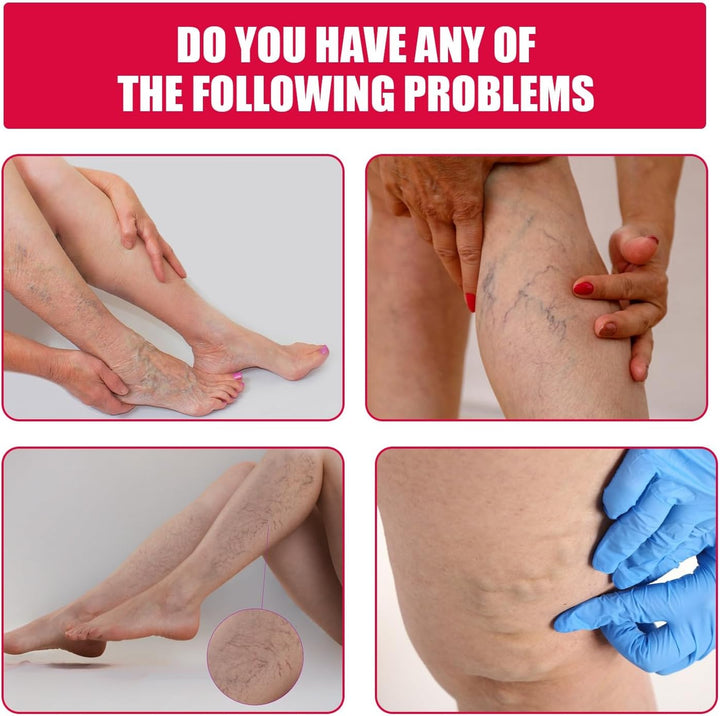 Varic/Ose Ve/Ins Treatment for Legs,Natural Varic/Ose Ve/Ins Cream,Varic/Ose Ve/Ins Treatment Cream,Cream for Varic/Ose Ve/Ins in Legs,Spi/Der V/Eins Repair Cream,Varic/Ose Ve/Ins Relief Cream