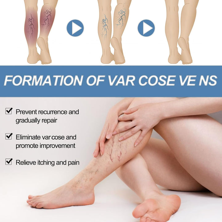 Varicos/E Ve/Ins Treatment for Legs,Varic/Ose Ve/Ins Treatment Cream,Sp/Ider Ve/Ins Repair Cream,Varicos/E Vein/S Cream,Spi/Der Vei/N Removal,Cre/Am for Varic/Ose V/Eins,Safe Formula,Portable