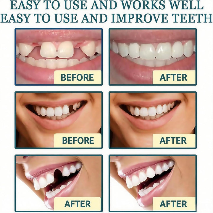 Advanced Full Denture Set,Silicone Reline Denture Set for Women,Soft Denture Reline Kit,Silicone Soft Dentures Repair,Snap on Veneers Teeth Upper & Lower,Silicone Dentures Full Mouth,Full Denture Set