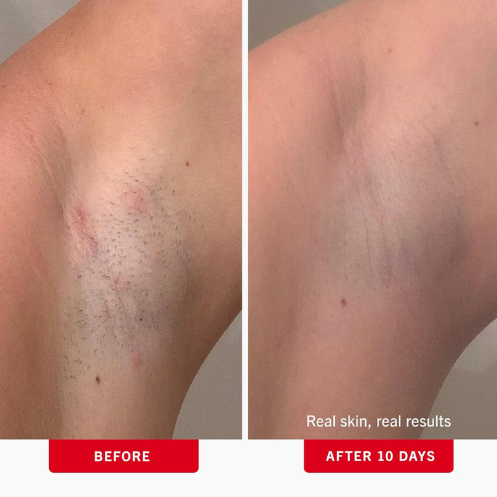 Ingrown Hair Pads with BHA & AHA – Daily Treatment Relieves Razor Burn, Prevents Ingrown Hairs and Soothes Irritation – 28 Pads