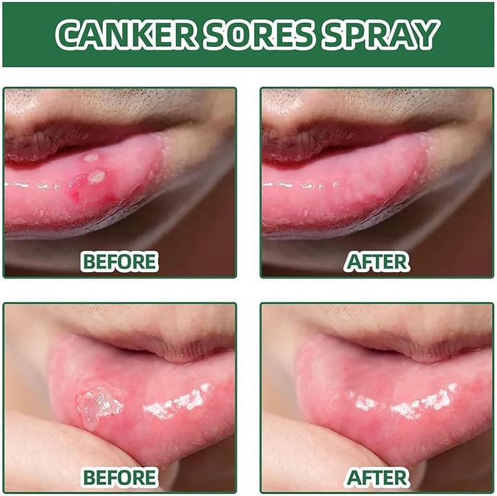 Mouth Ulcer Treatment Spray,Mouth Ulcer Treatment for Adults,Canker Sore Relief Treatment,Herbal Mouths Sprays for Ulcer Treatments,Dry Mouth Relief,Breath Freshener Spray(Pack of 1)