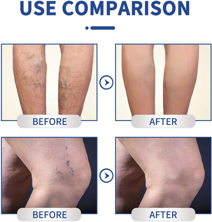 2PCS Bee Venom Varicos/E Ve/Ins Treatment for Legs,Varicos/E Vein/S Treatment Cream,Varico/Se Relief Vei/Ns Cream,Tired and Heavy Legs Relief,Improve Leg Appearance,Relaxing Leg Cream,Non-Greasy