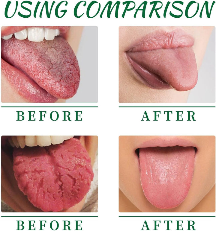 2Pcs Tongue Repair Spray,Sore Tongue Relief,Breath Fresheners,Fissured Tongu/E Relief Spray,Tongu/E Moisturizing S/Pray,Instant Dry Mouth R/Elief,Mou/Th Spra/Y for Dryness