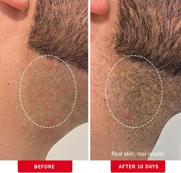 Ingrown Hair Pads with BHA & AHA – Daily Treatment Relieves Razor Burn, Prevents Ingrown Hairs and Soothes Irritation – 28 Pads