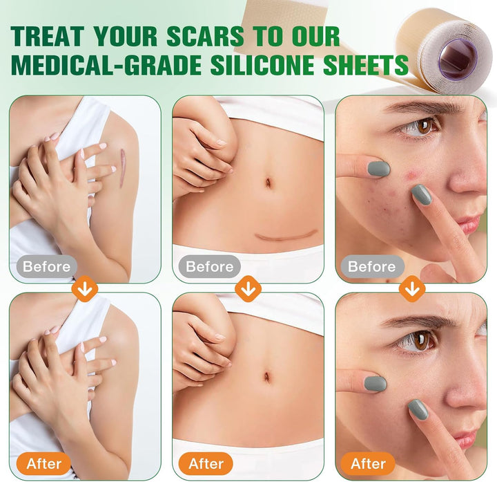 Silicone Scar Tape, Silicone Scar Sheets(1.6" X 75" Roll-1.9M), Medical Grade Scar Tape, Reusable Silicone Tape for Surgical Scar, C-Section, Keloid
